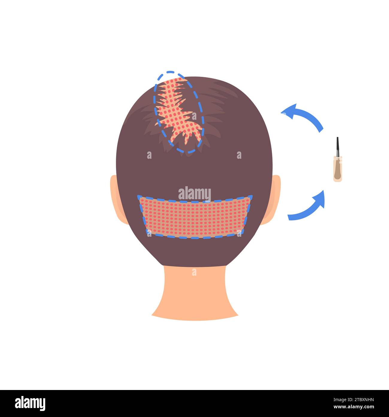 FuE-Haartransplantation, konzeptuelle Illustration Stockfoto