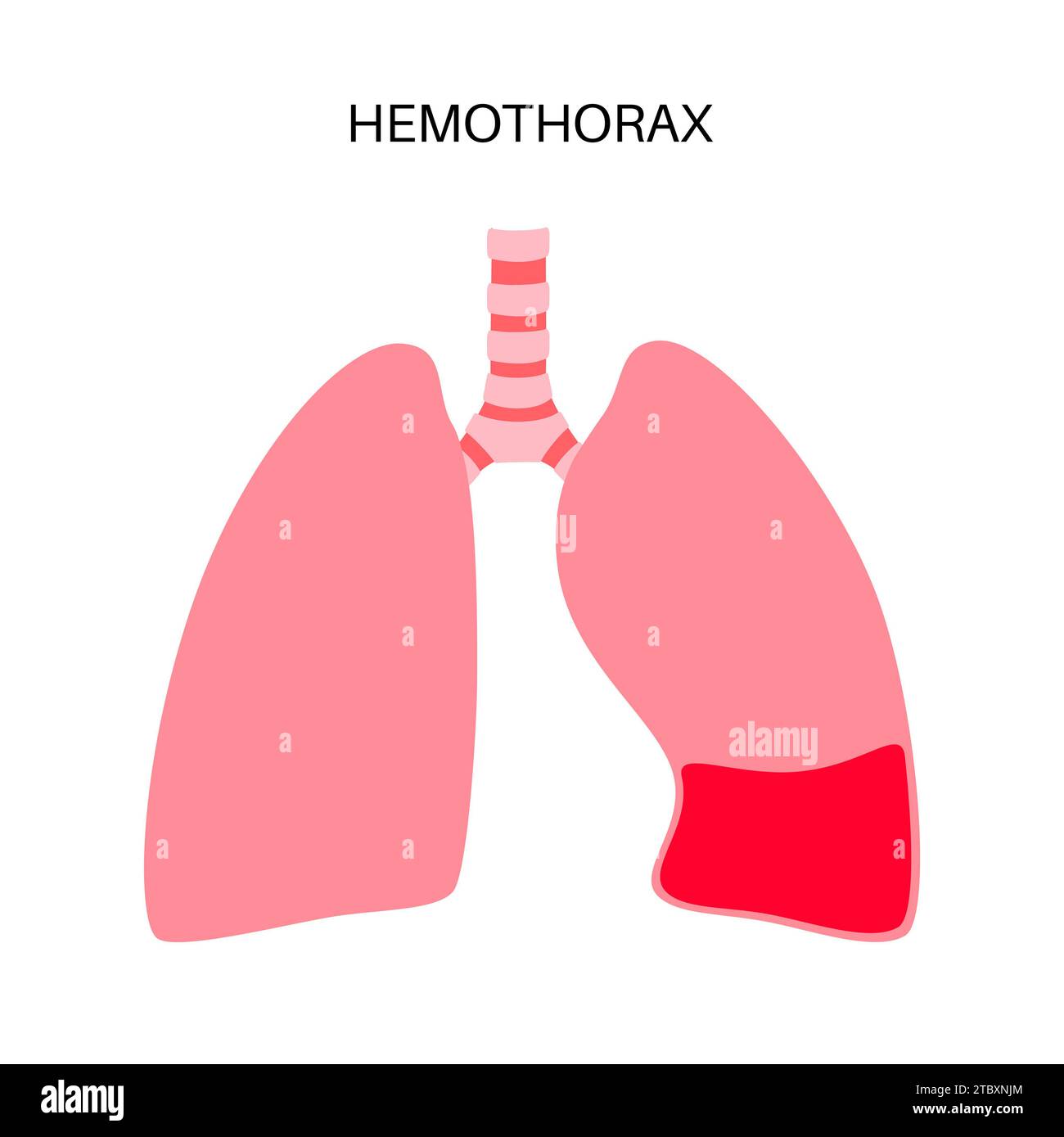 Hämatothorax, Illustration Stockfoto