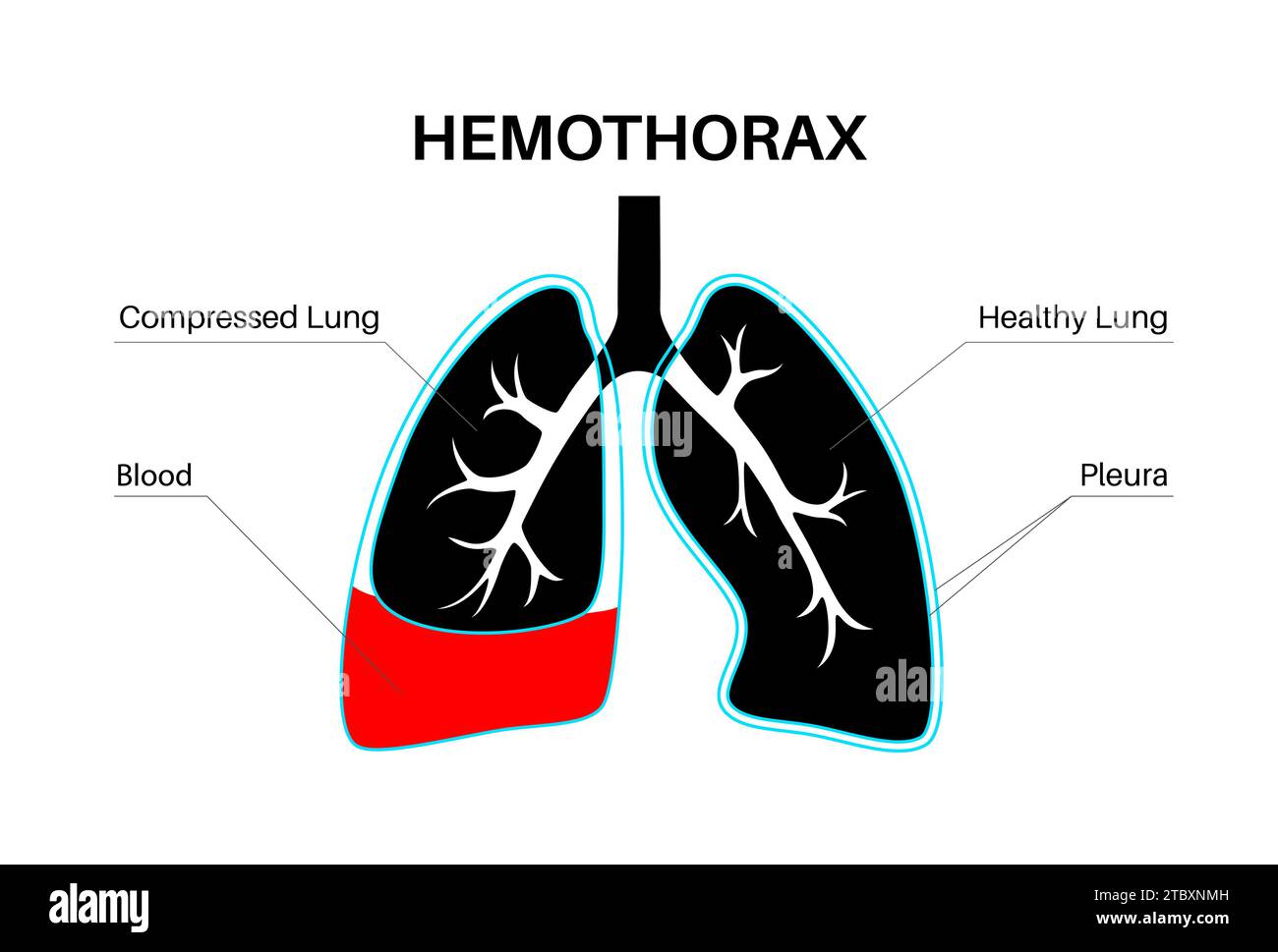Hämatothorax, Illustration Stockfoto