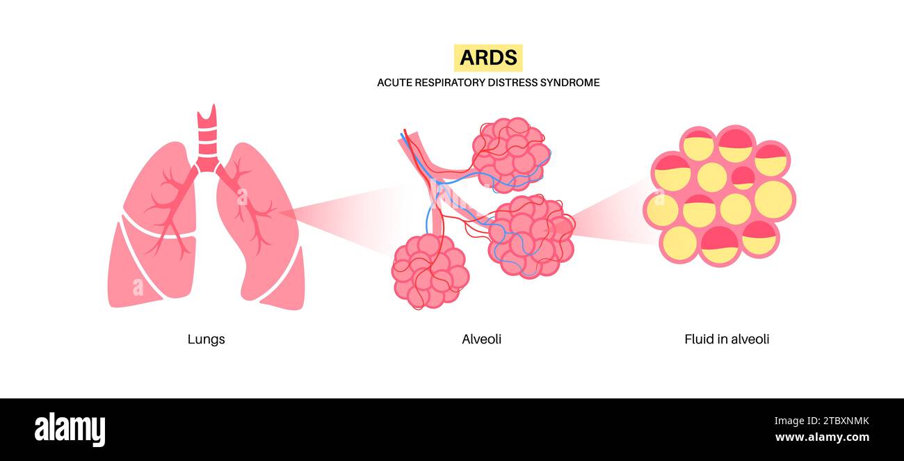 Akute Atemnot, Illustration Stockfoto