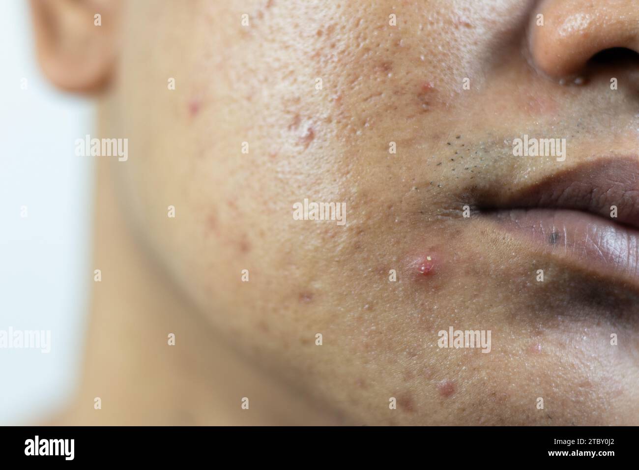 Hautprobleme. Zur Frage der entzündeten Akne im Gesicht. Entzündete Akne besteht aus Schwellungen, Rötungen und Poren, die stark mit Bakterien verstopft sind, o Stockfoto