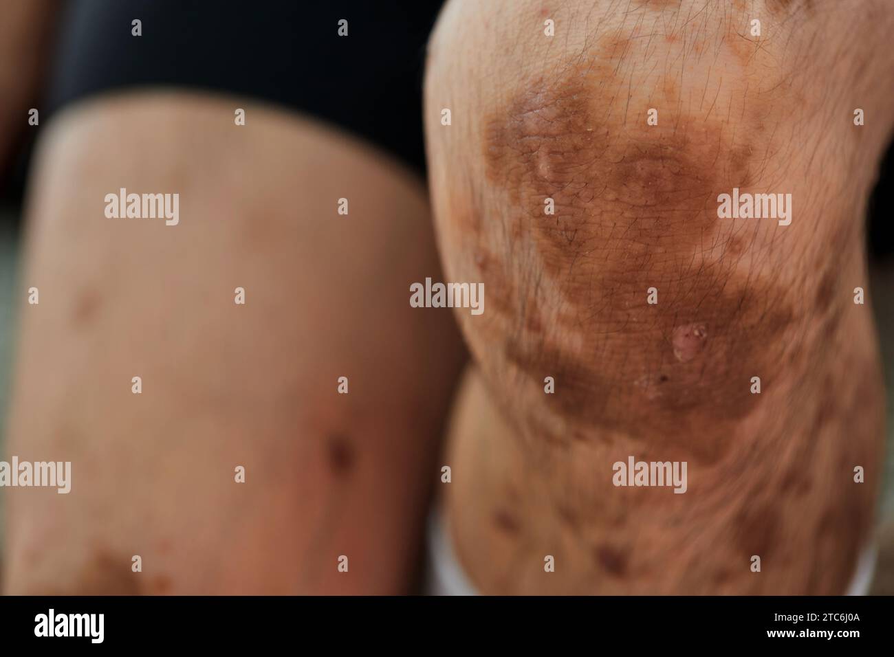 Nahaufnahme chronischer Hauterkrankungen Dermatitis Stockfoto