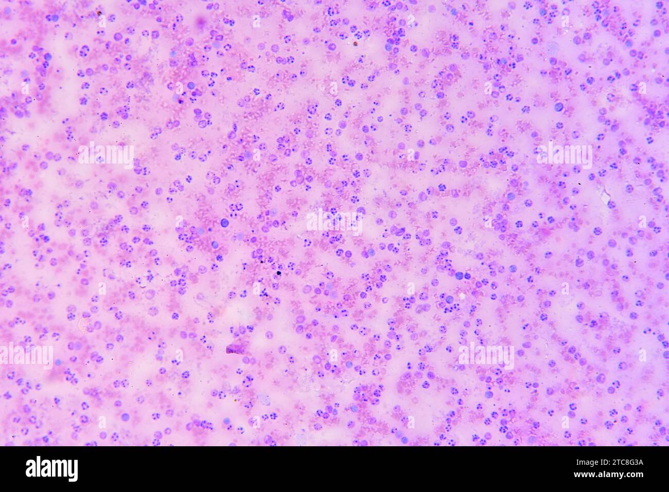 Rote Blutkörperchen mit Plasmodium infiziert, verantwortlich Parasiten für Malaria. Optisches Mikroskop X200. Stockfoto