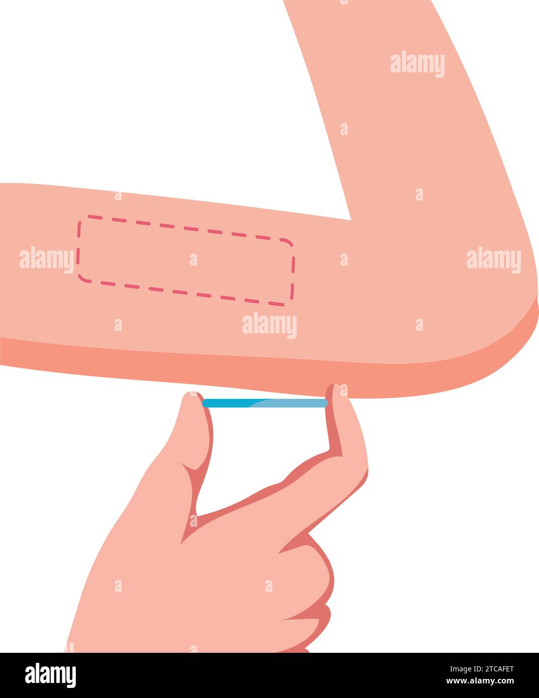 Die kontrazeptive Implantatprophylaxe der Frau Stock Vektor