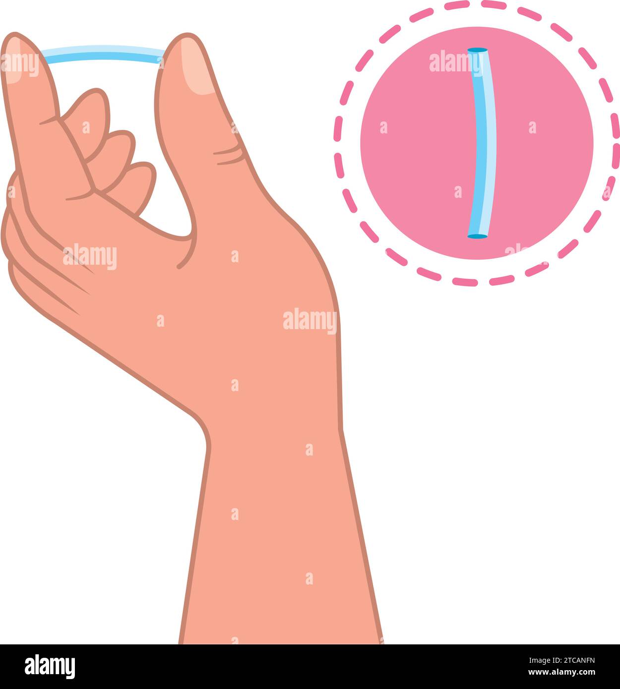 Kontrazeptives Implantatdesign Stock Vektor