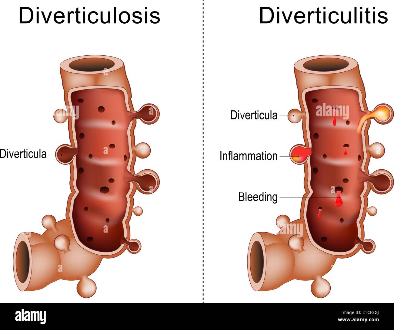 Der Unterschied zwischen Divertikulitis und Divertikulose-Kolon. Nahaufnahme eines Teils des Dickdarms mit Divertikeln, Blutungen und Entzündungen, Hum Stock Vektor