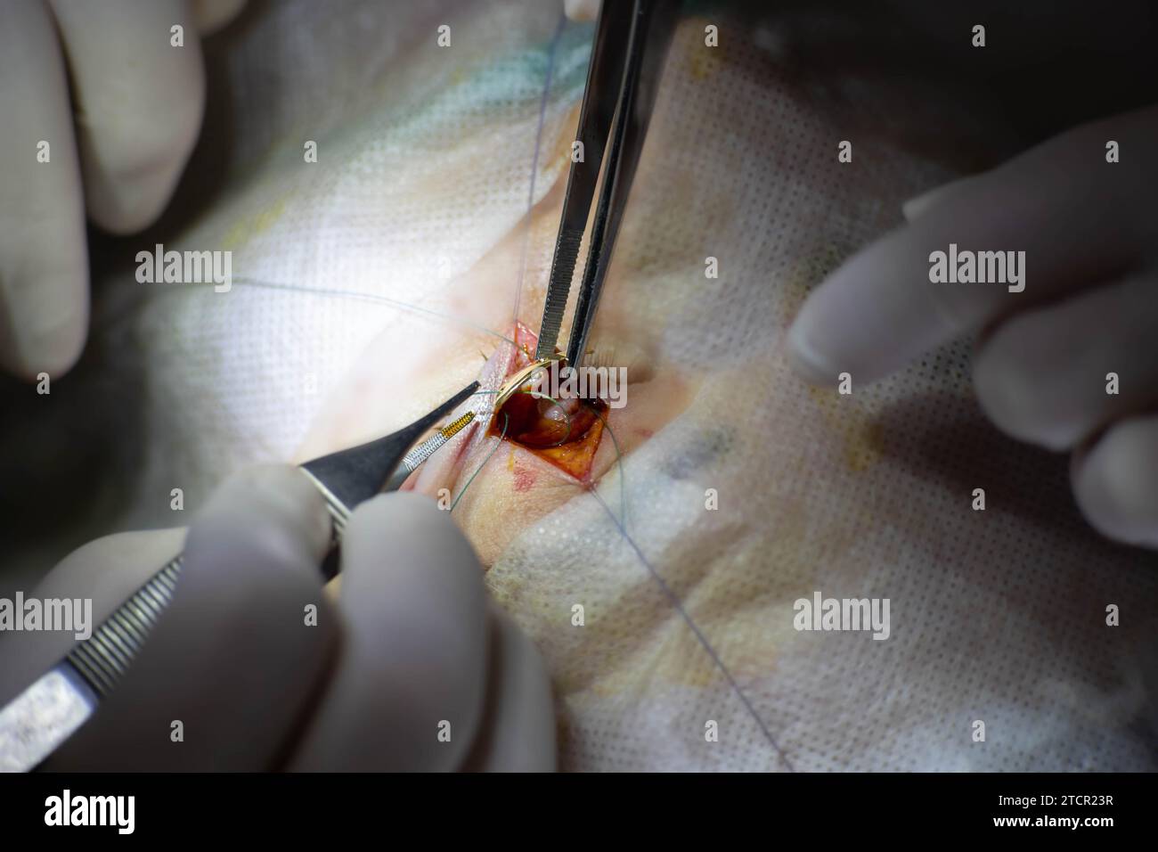 Einzigartige chirurgische Operation bei Neuritis des Nervus facialis, Implantation eines Goldimplantats in die Augenlider, bevor sich das Auge nicht schließt. Goldenes Augenlid Stockfoto
