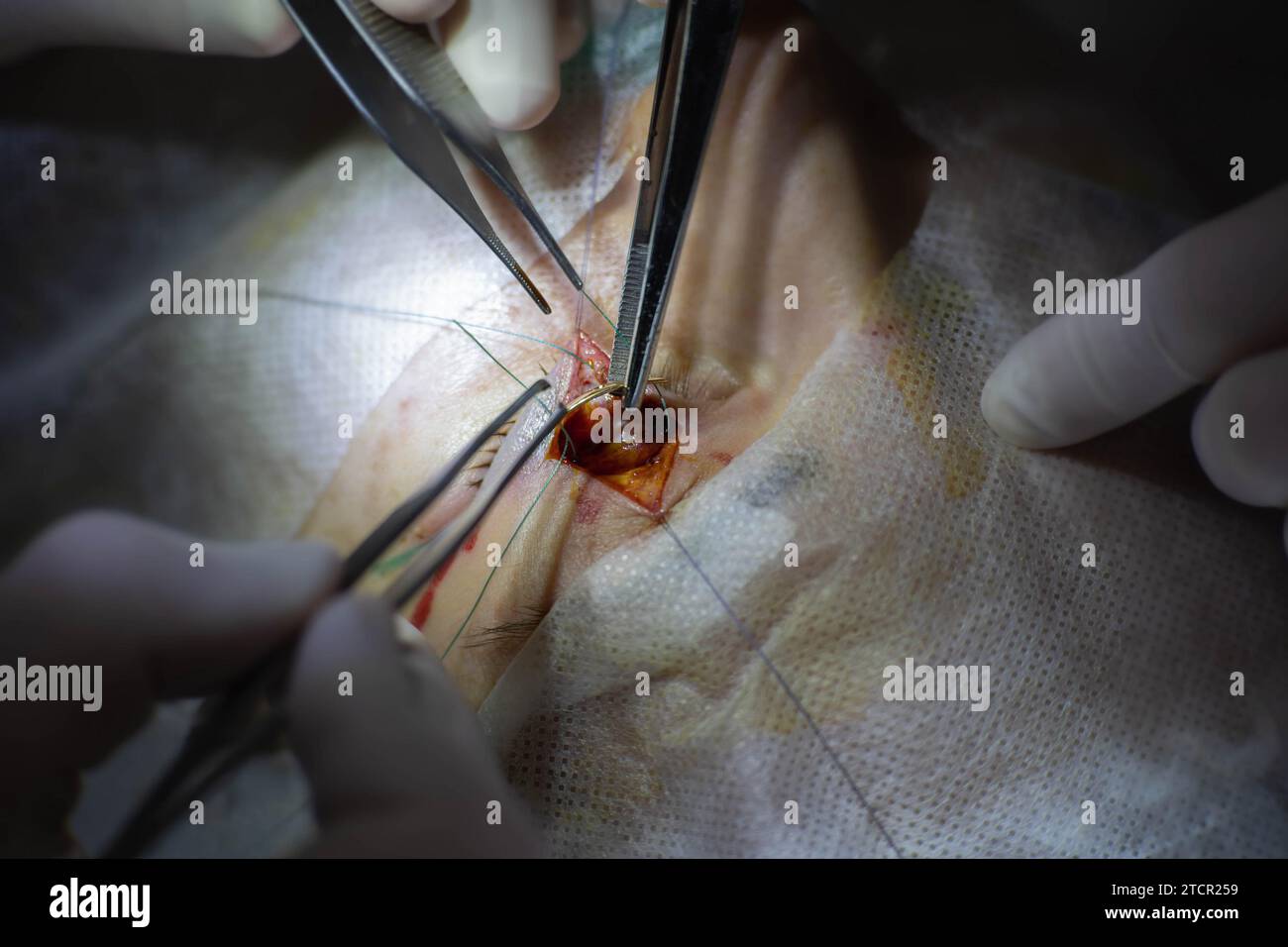 Einzigartige chirurgische Operation bei Neuritis des Nervus facialis, Implantation eines Goldimplantats in die Augenlider, bevor sich das Auge nicht schließt. Goldenes Augenlid Stockfoto
