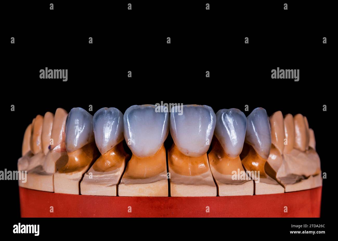 Keramikbrücke auf Implantaten Stockfoto