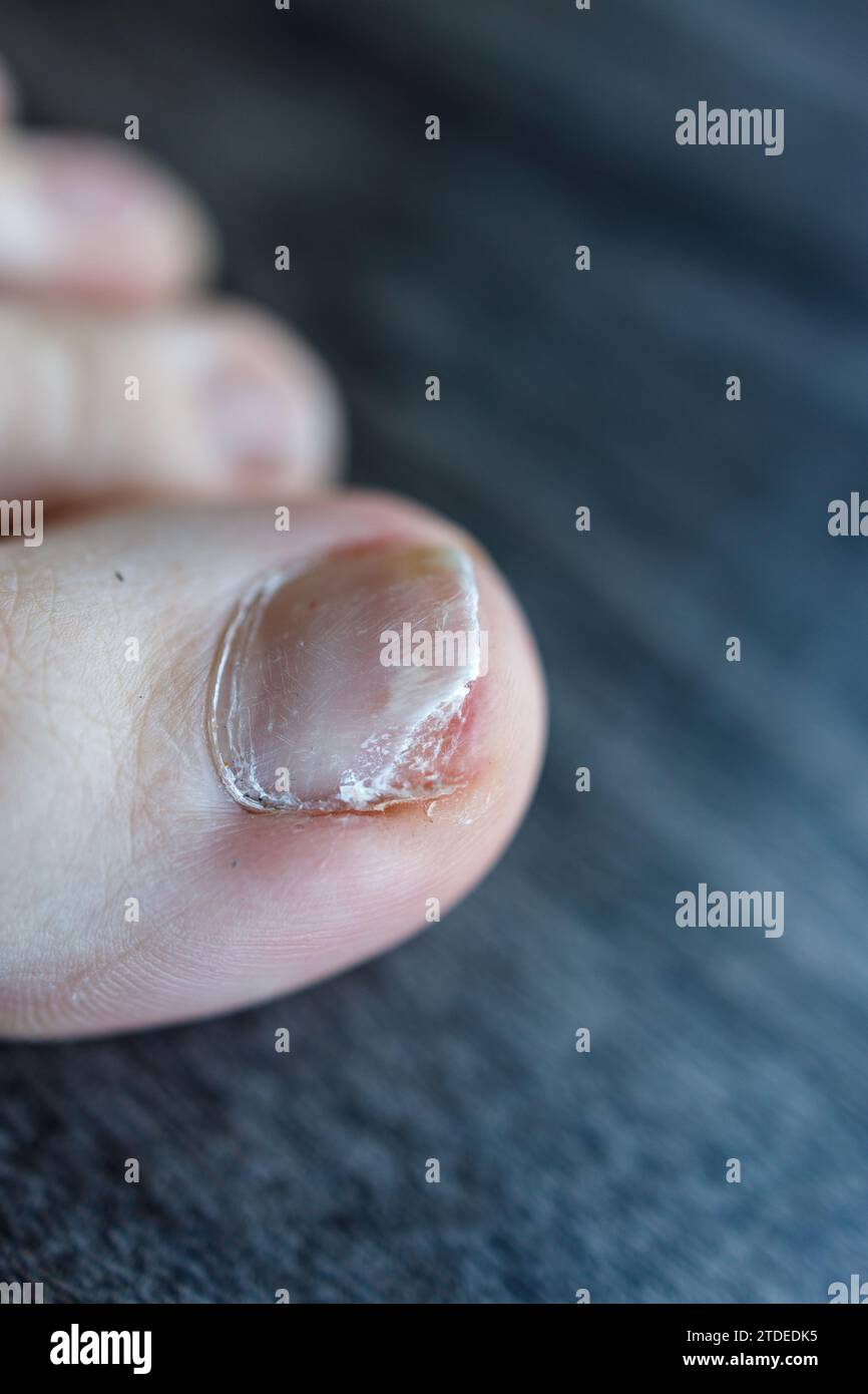 Nahaufnahme einer partiellen Ablösung des Zehennagels vom Nagelbett durch Onycholyse, Pilzinfektion Stockfoto