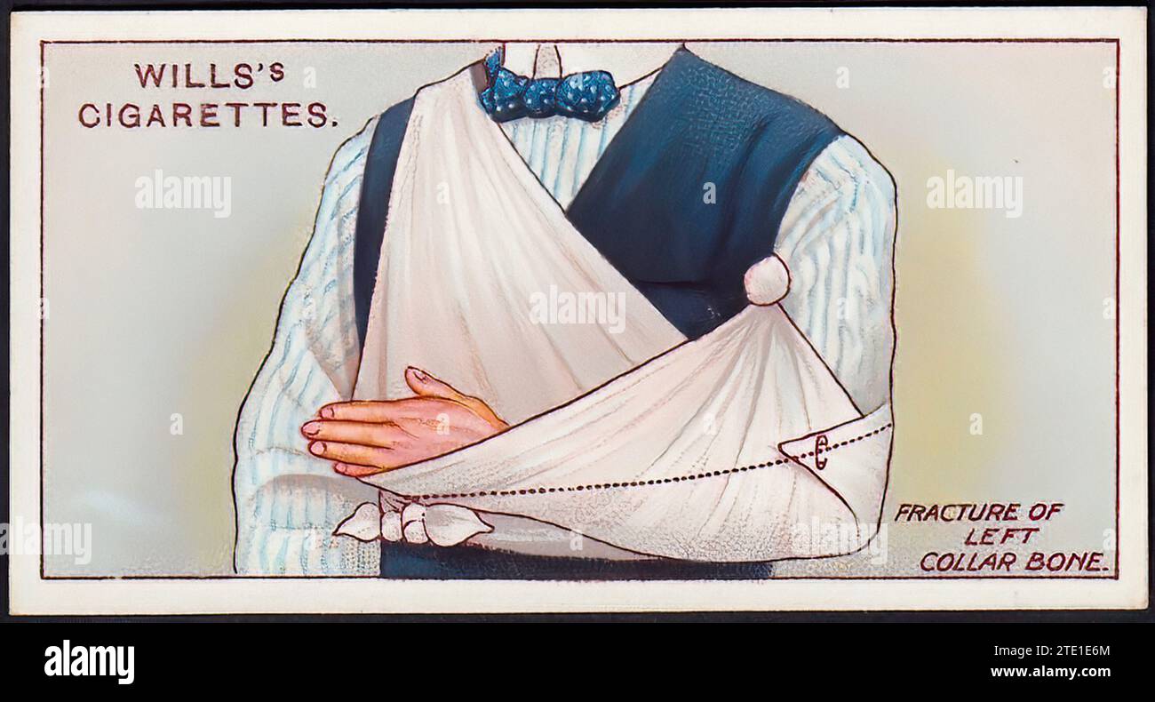 Erste Hilfe, Fraktur des linken Halsknochens - Vintage Zigarettenkarte Illustration Stockfoto