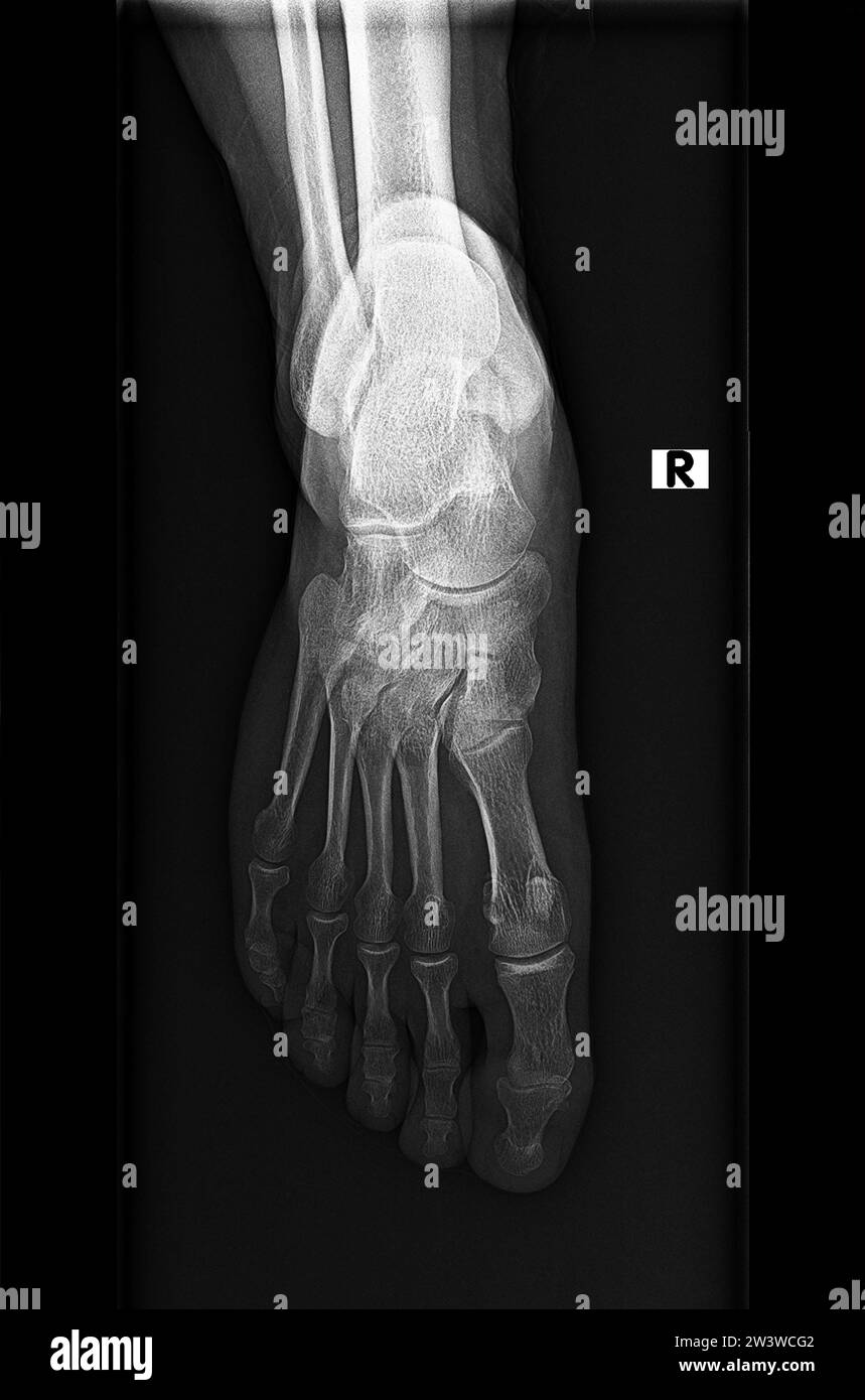 Normale Röntgenaufnahme, Röntgenaufnahme oder Röntgenaufnahme des Fuss- und Sprunggelenks bei anteroposteriorer (AP) Projektion, Traumatologie und Orthopädie, Rheumatologie Stockfoto