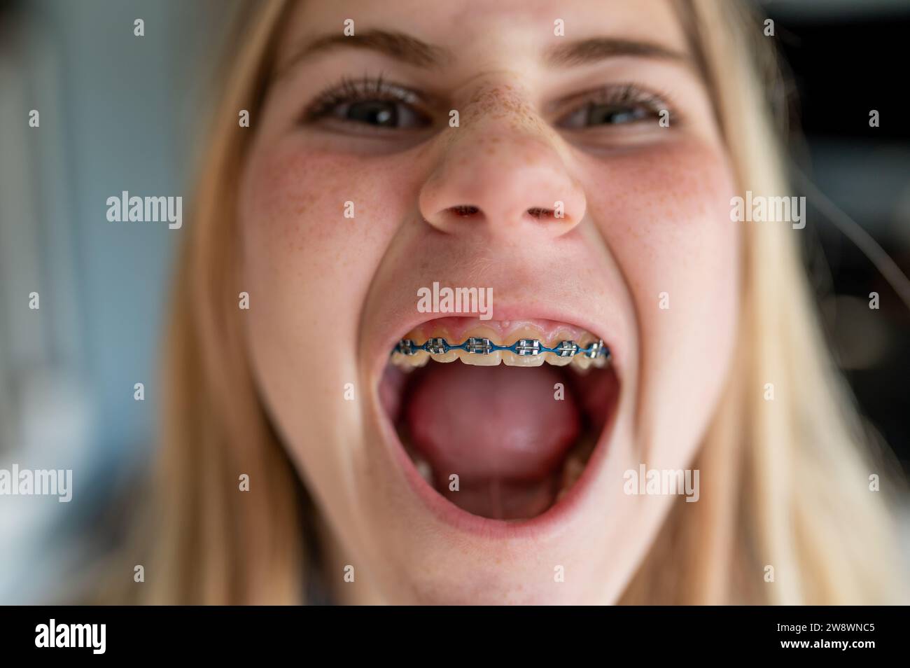 Tween Mädchen mit Zahnspange und offenem Mund Stockfoto