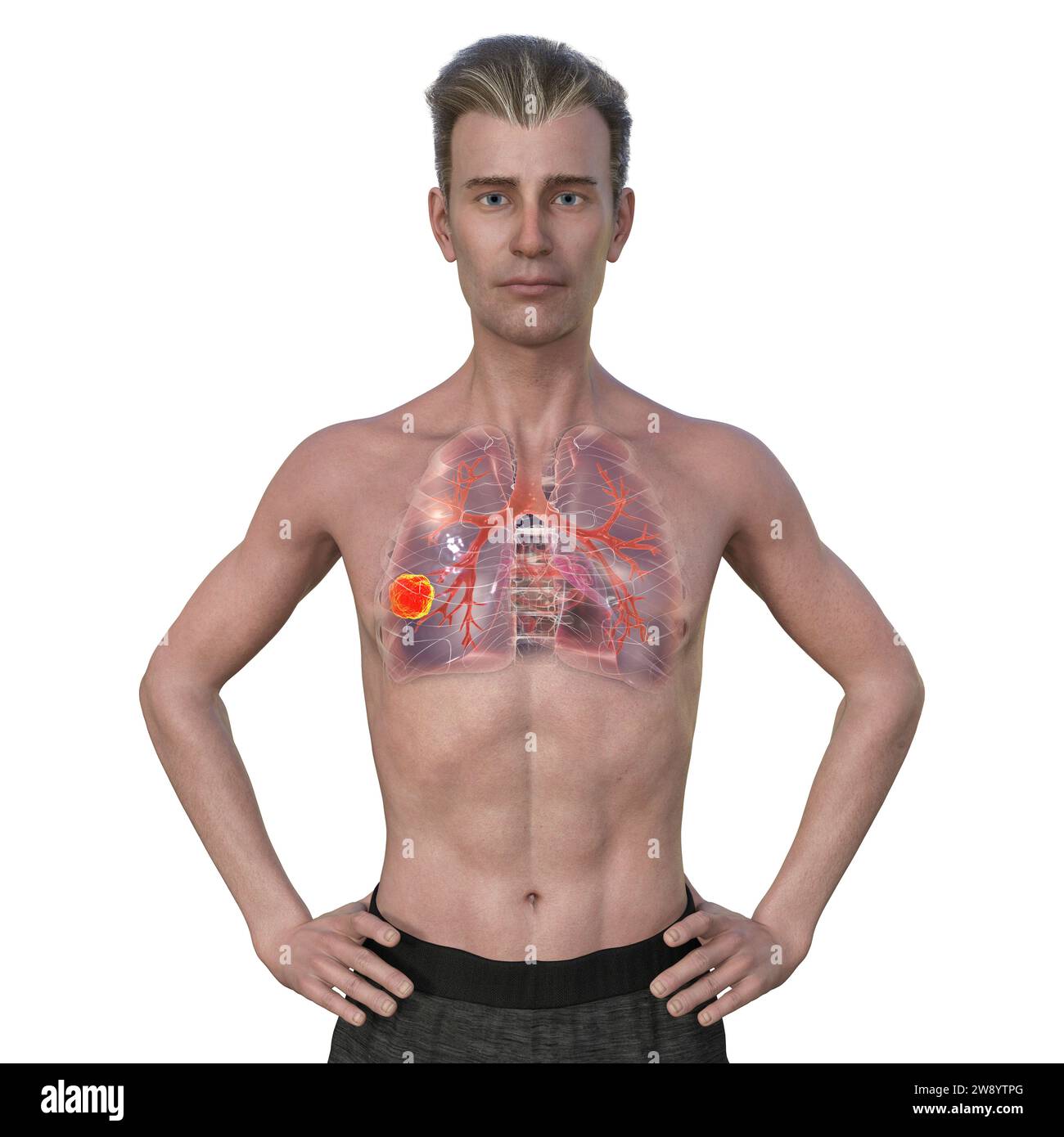 Mann mit Lungenkrebs, Illustration Stockfoto