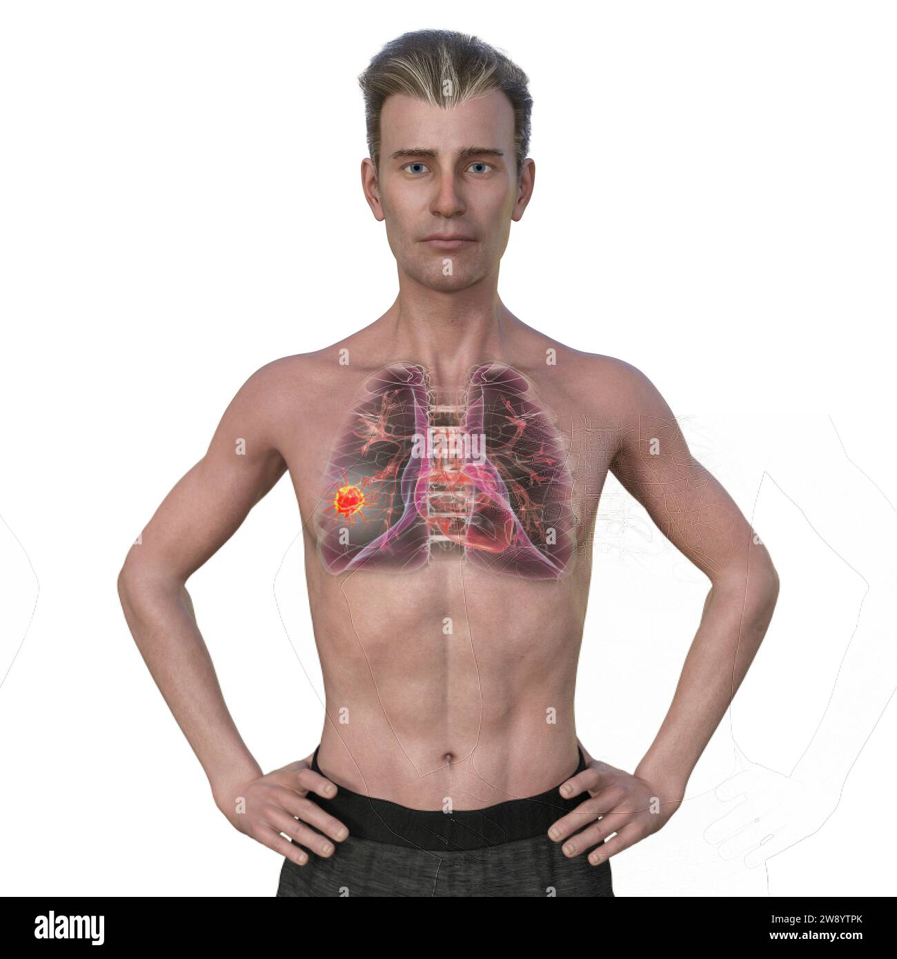 Mann mit Lungenkrebs, Illustration Stockfoto