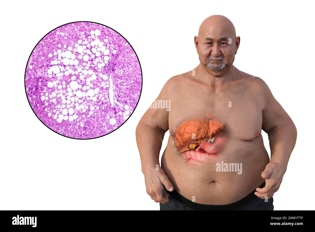 Übergewichtiger Mann mit Lebersteatose, Illustration Stockfoto