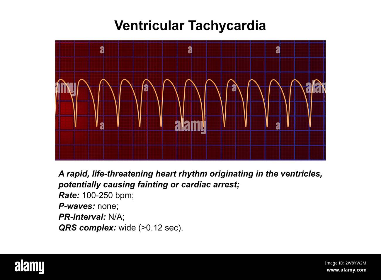 Ventricular tachycardia Ausgeschnittene Stockfotos und bilder Alamy
