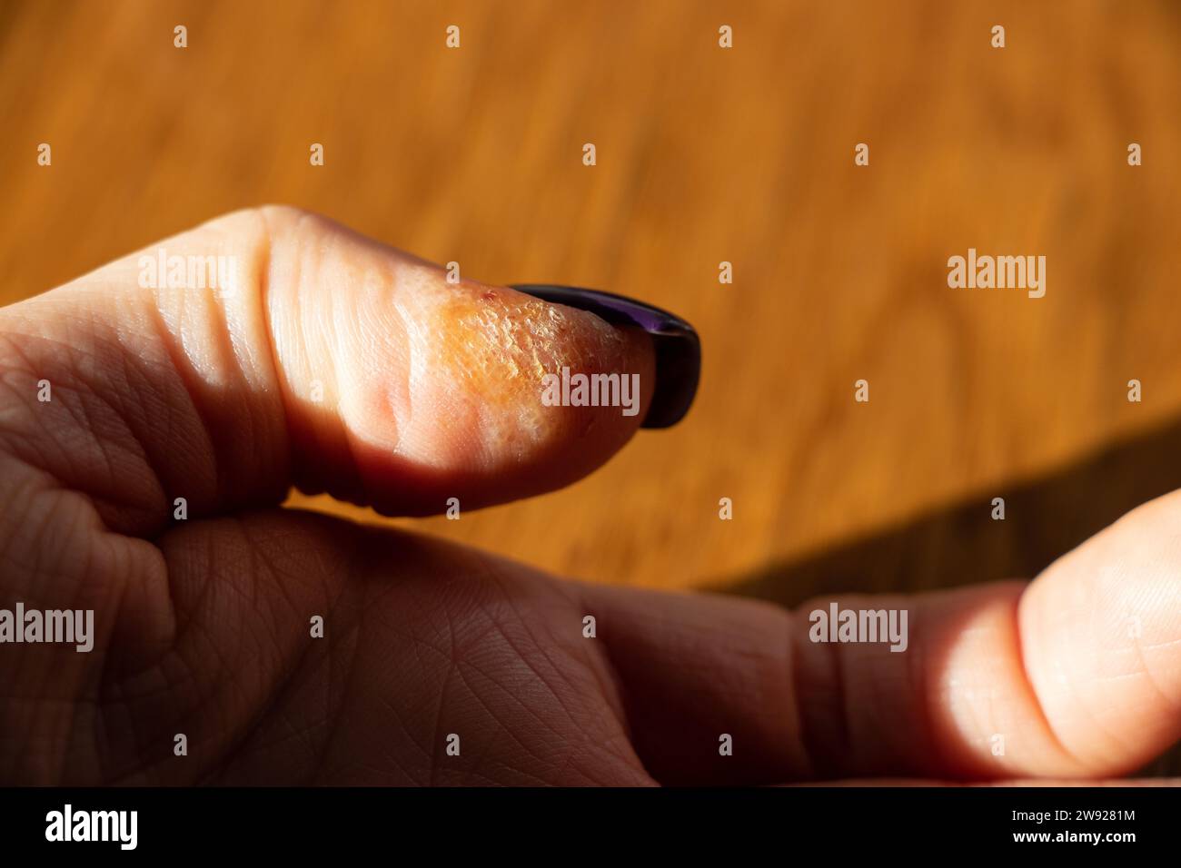 Allergische Reaktion und Hautausschlag am Finger, Hautirritationen, trockene Haut in Nahaufnahme Stockfoto