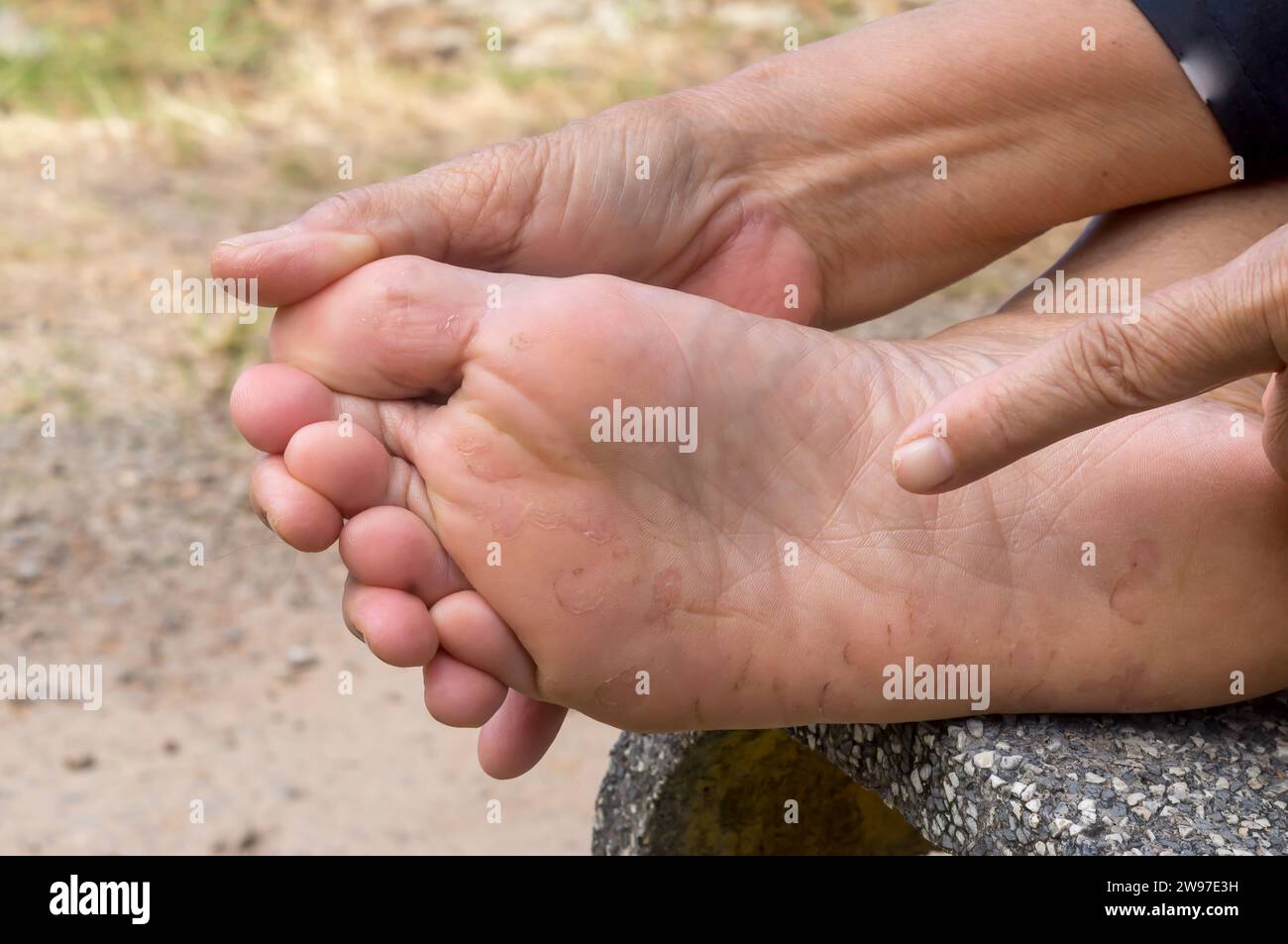 Frau Hand zeigt auf Fußschmerzen, die durch Athleten Fuß verursacht wurden. Der Patient leidet an einer schweren Fußhauterkrankung. Nahaufnahme der Fußkrankheit Stockfoto