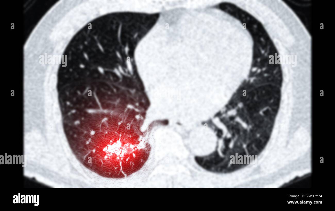 CT-Scan von Thorax- oder Lungenachsenaufnahmen mit Lungenkarzinom Lungenkarzinom. Stockfoto