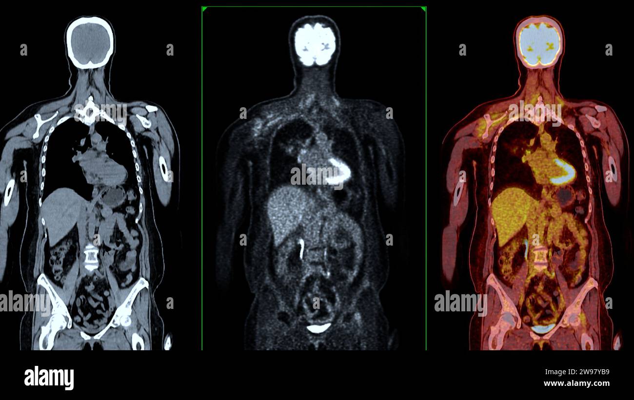 PET CT-Scan-Fusion-Bild es liefert detaillierte Bilder, indem die ...