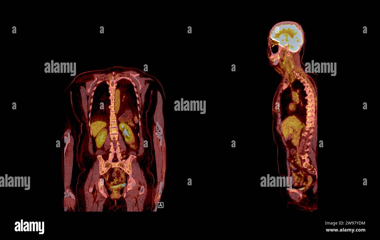 PET CT-Scan-Fusion-Bild es liefert detaillierte Bilder, indem die ...