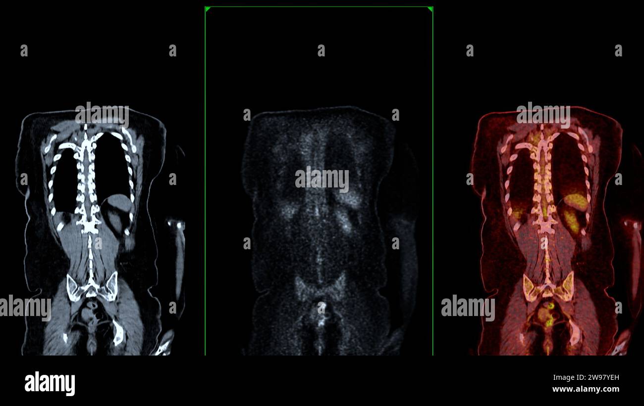 PET CT-Scan-Fusion-Bild es liefert detaillierte Bilder, indem die ...