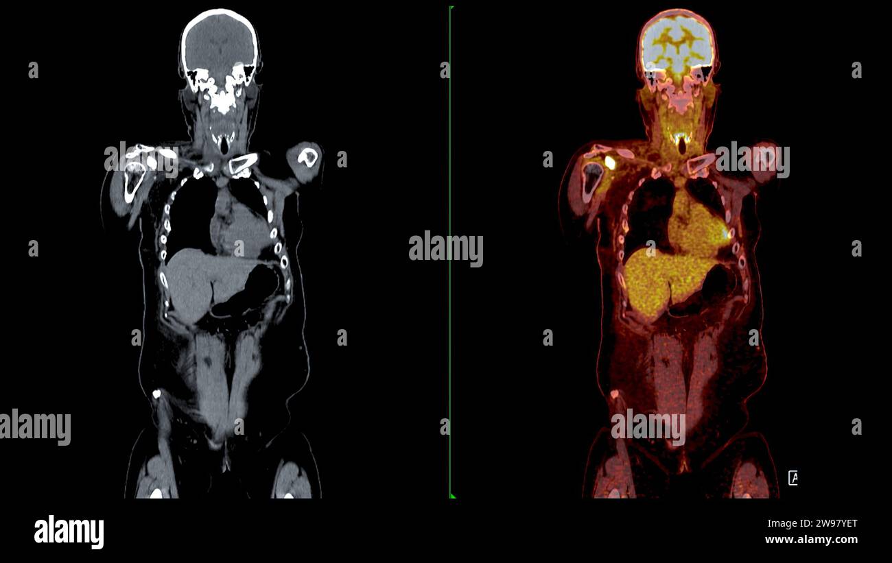 PET CT-Scan-Fusion-Bild es liefert detaillierte Bilder, indem die ...