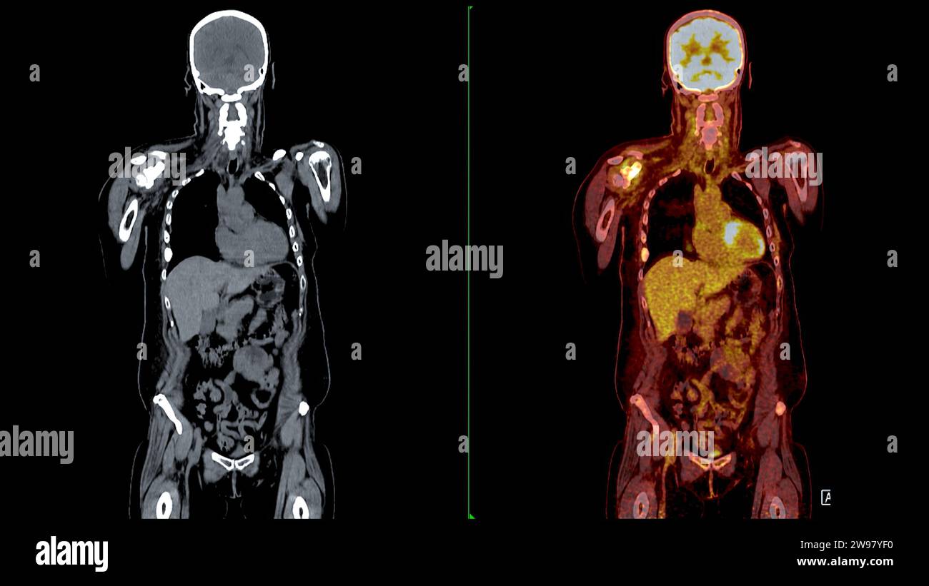 PET CT-Scan-Fusion-Bild es liefert detaillierte Bilder, indem die ...