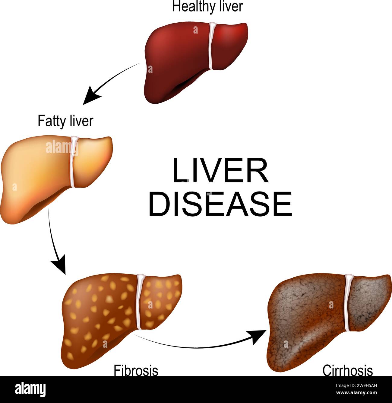 Lebererkrankungen. Gewebsveränderungen eines menschlichen inneren Organs von gesunder und fetter Leber zu Fibrose und Zirrhose. Stadien der Leberschädigung. Vektorillu Stock Vektor