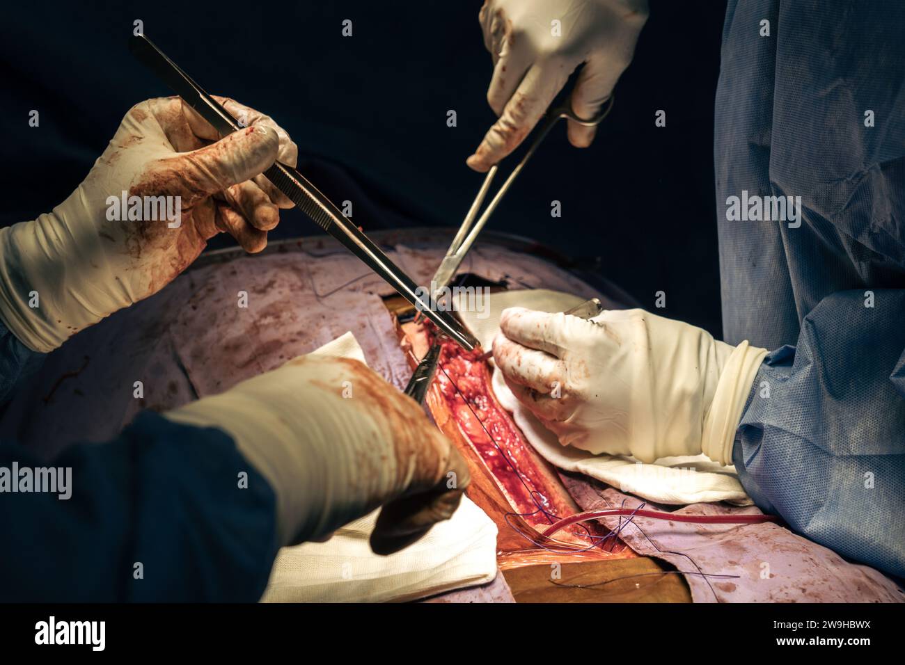 Nahaufnahme von Chirurgenhänden mit Skalpell bei Operation im Operationssaal des Krankenhauses. Skoliosechirurgie. Stockfoto