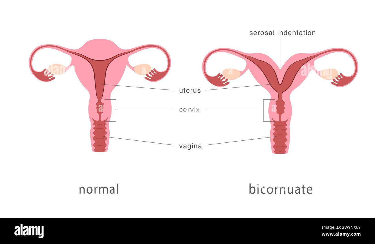 Bicornuate und normale menschliche Gebärmutterstruktur. Das tiefe Septum des Uterus als angeborene Uterusmissbildung. Anatomiediagramm. Stock Vektor