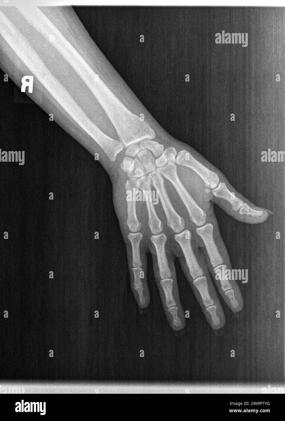 Filmröntgenaufnahme oder Röntgenaufnahme einer normalen linken Hand eines erwachsenen Mannes. AP-Ansicht zeigt die menschliche Hand. Die normale Knochenstruktur aller Phalangen-Karpalknochen Metacar Stockfoto