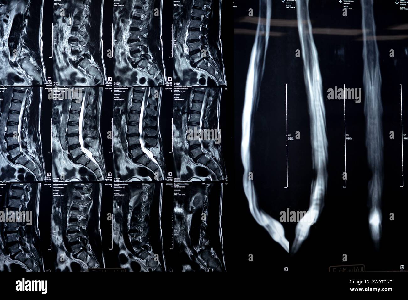 Kairo, Ägypten, 24. Dezember 2023: L5 Wirbelsäulenlaminektomie, posteriore Thekalsackdekompression, lumbale Spondylose, posteriore Bandscheibenprotr Stockfoto