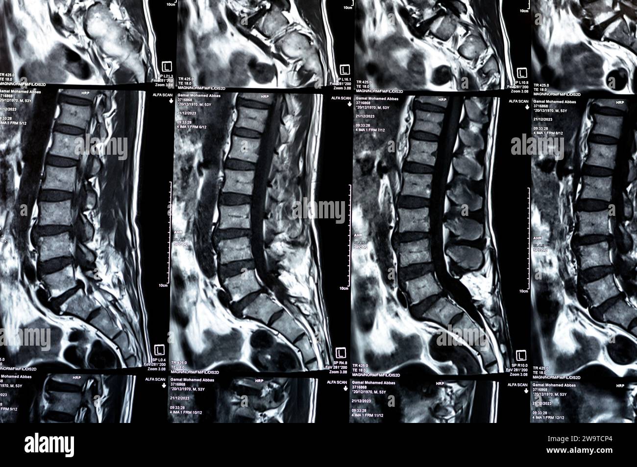 Kairo, Ägypten, 24. Dezember 2023: L5 Wirbelsäulenlaminektomie, posteriore Thekalsackdekompression, lumbale Spondylose, posteriore Bandscheibenprotr Stockfoto