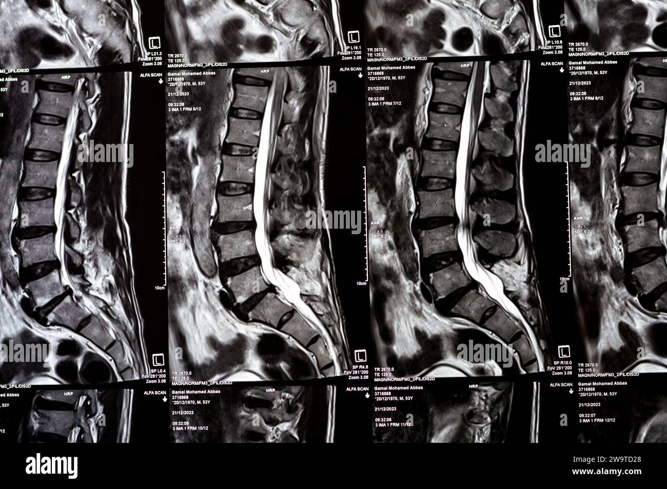 Kairo, Ägypten, 24. Dezember 2023: L5 Wirbelsäulenlaminektomie, posteriore Thekalsackdekompression, lumbale Spondylose, posteriore Bandscheibenprotr Stockfoto
