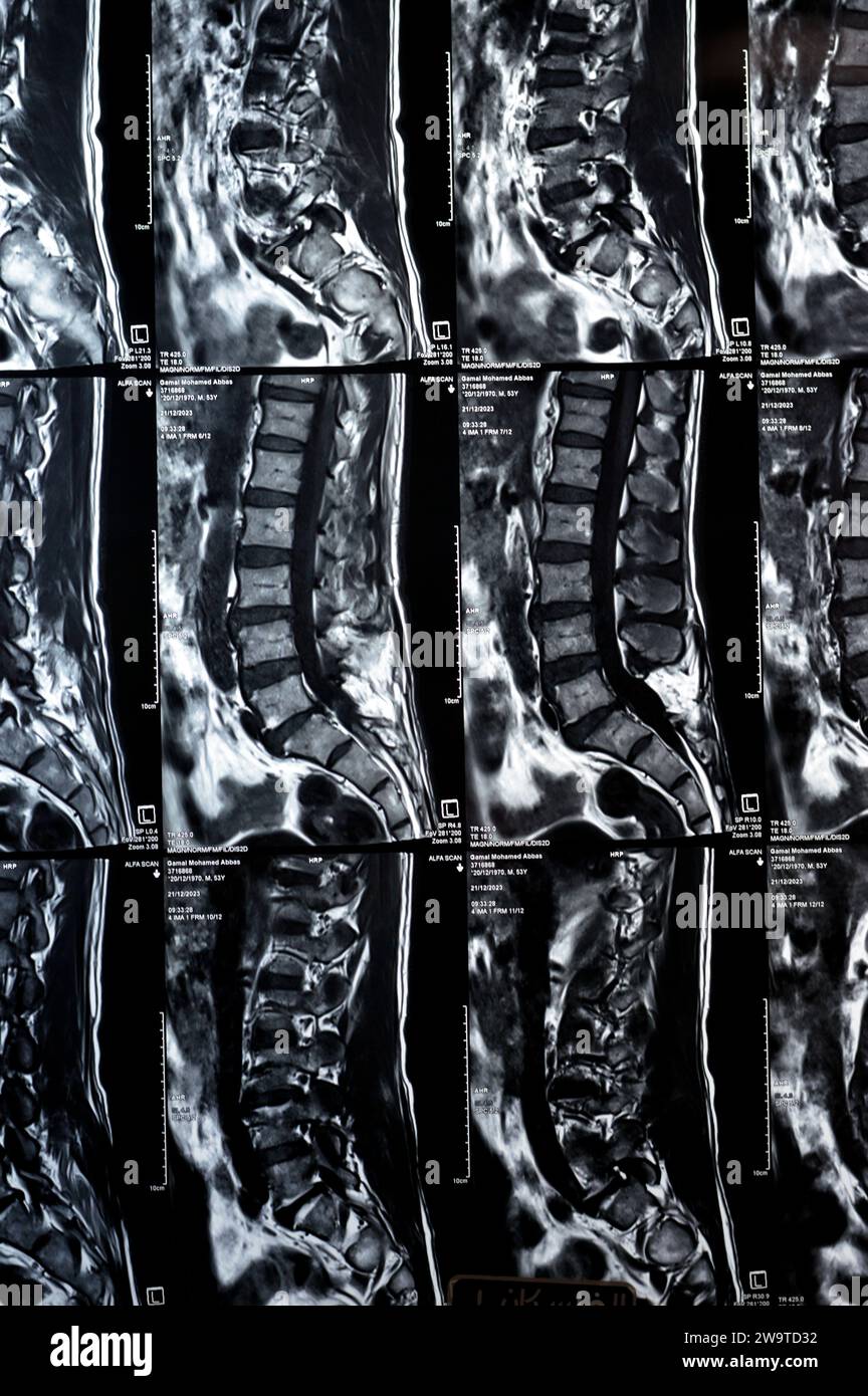 Kairo, Ägypten, 24. Dezember 2023: L5 Wirbelsäulenlaminektomie, posteriore Thekalsackdekompression, lumbale Spondylose, posteriore Bandscheibenprotr Stockfoto