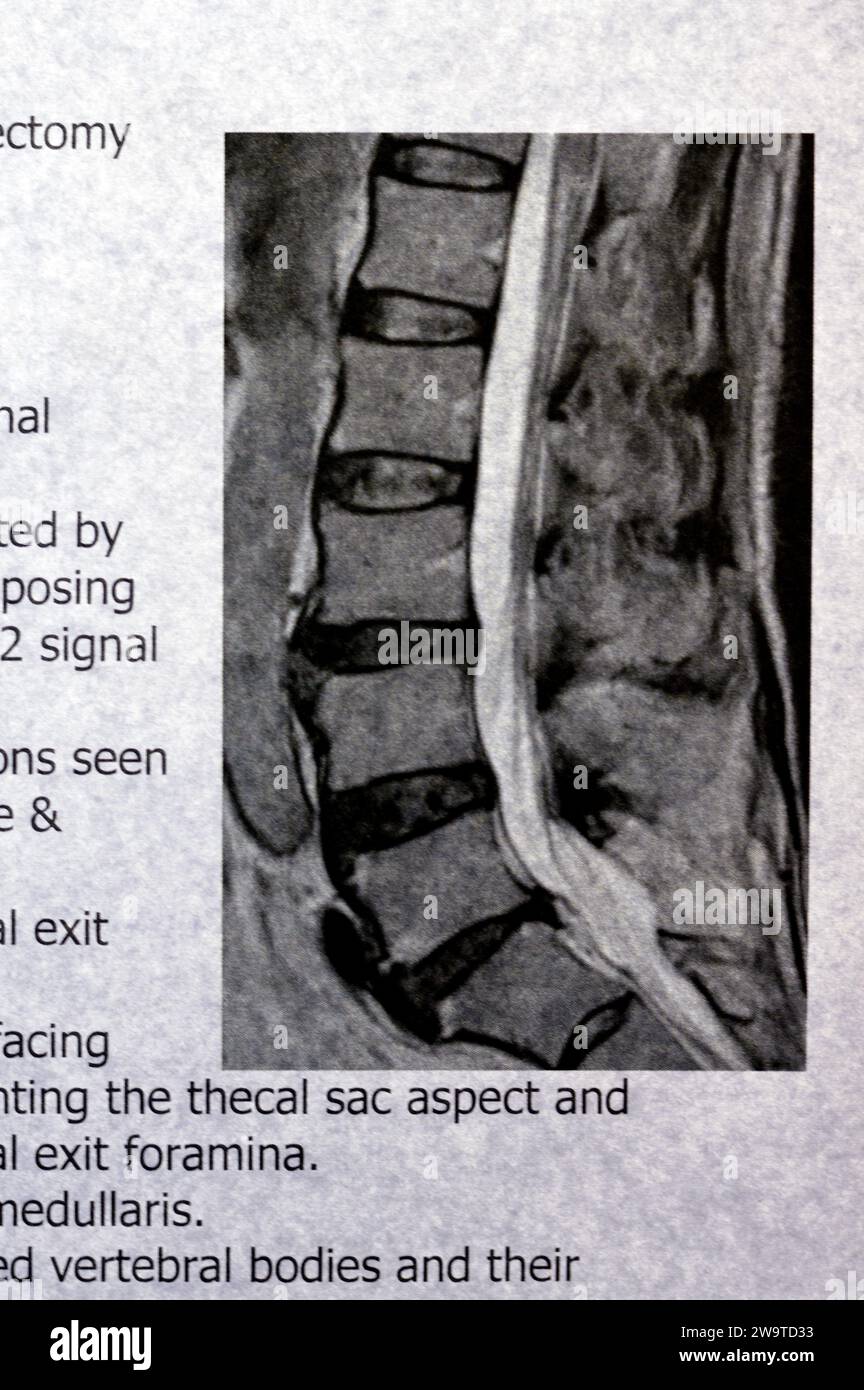 Die lumbosakrale Wirbelsäule zeigt L5-Wirbelsäulenlaminektomie, posteriore Thekalsackdekompression, lumbale Spondylose, posteriore Bandscheibenprotrusio Stockfoto