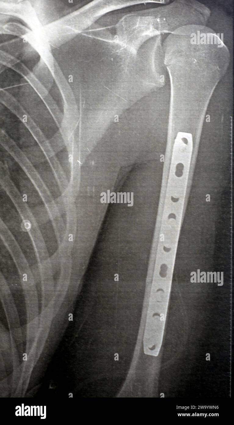 Einfaches Röntgenbild mit linker Oberarmfraktur im Mittelschaft durch direktes Trauma bei einem Autounfall, behandelt durch offene Reposition und innere Fixa Stockfoto