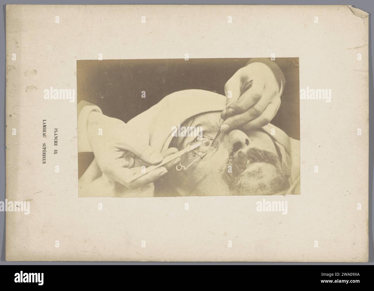 Operation am Obersten Augenlappen, A. de Montméja, um 1865 - vor ca. 1870 Foto Frankreich fotografische Trägeralbumendruckoperation, Chirurgie. Augenbehinderungen. Augen Stockfoto