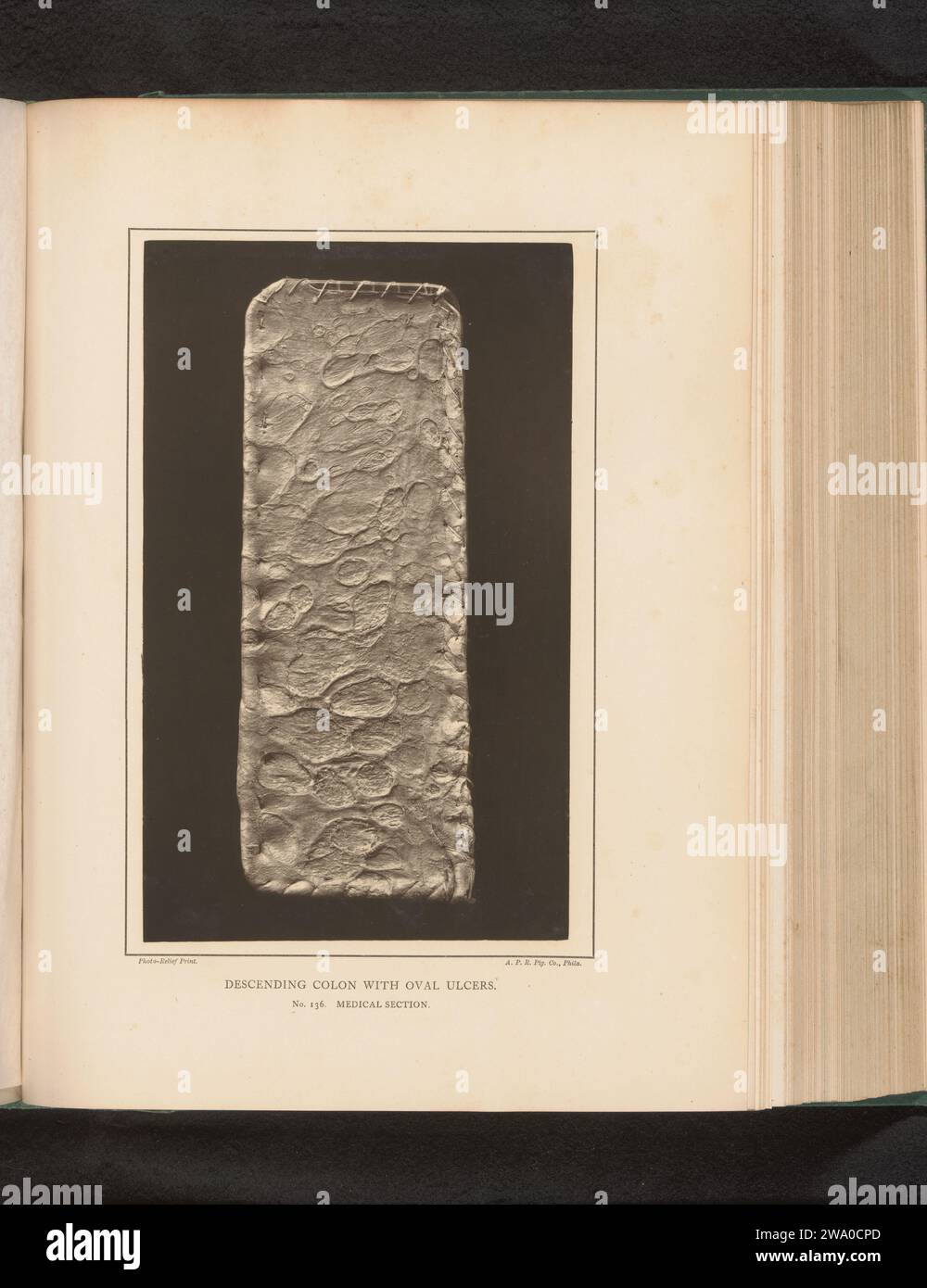 Gestrecktes Stück fallender Därme mit ovalen Ulzera, E. J. Ward, ca. 1874 - in oder vor 1879 photomechanischen Druck Philadelphia Paper intestines. Anatomische Probe. Ulkus Stockfoto
