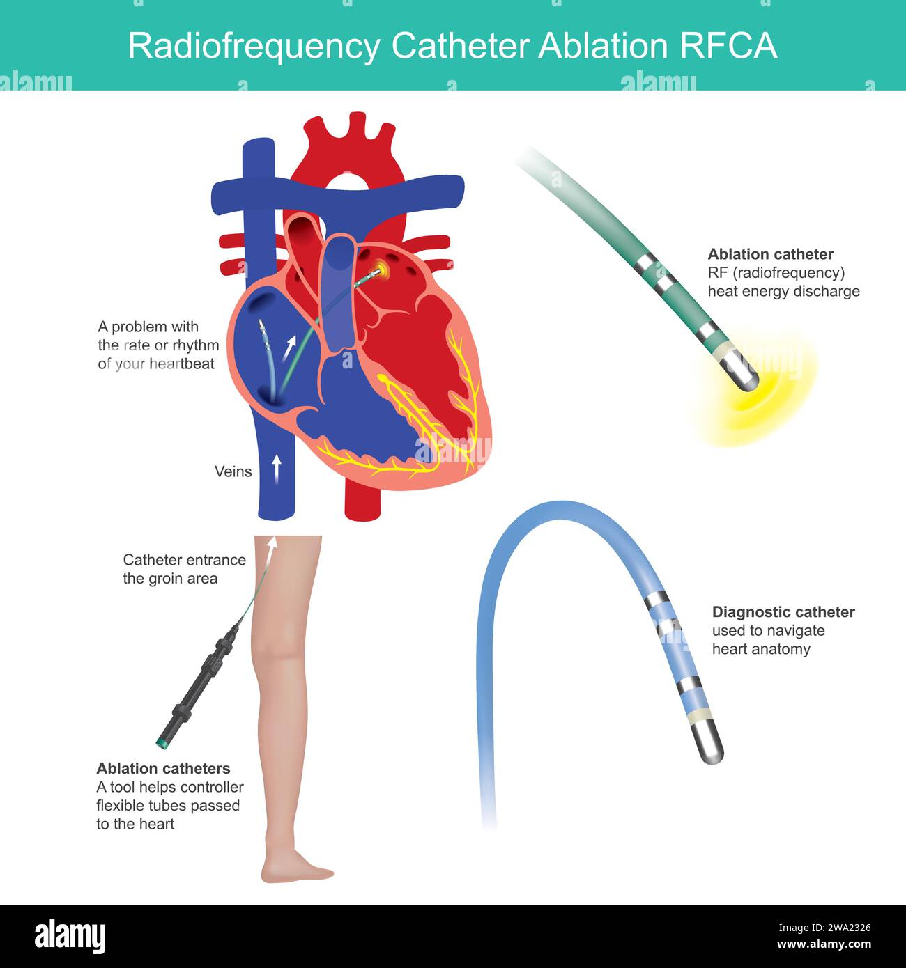 Radiofrequenz-Katheter-Ablation. Ein medizinisches Verfahren wird verwendet, um Herzrhythmusstörungen wie Vorhofflimmern zu kontrollieren. Stock Vektor