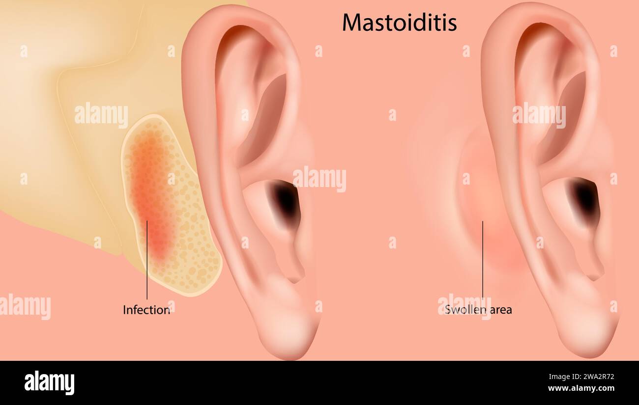 Mastoiditis. Entzündung der Schleimhautschleimhaut des Mastoidantrum und des Mastoidluftzellsystems innerhalb des Mastoidfortsatzes. Medizinisch Stock Vektor