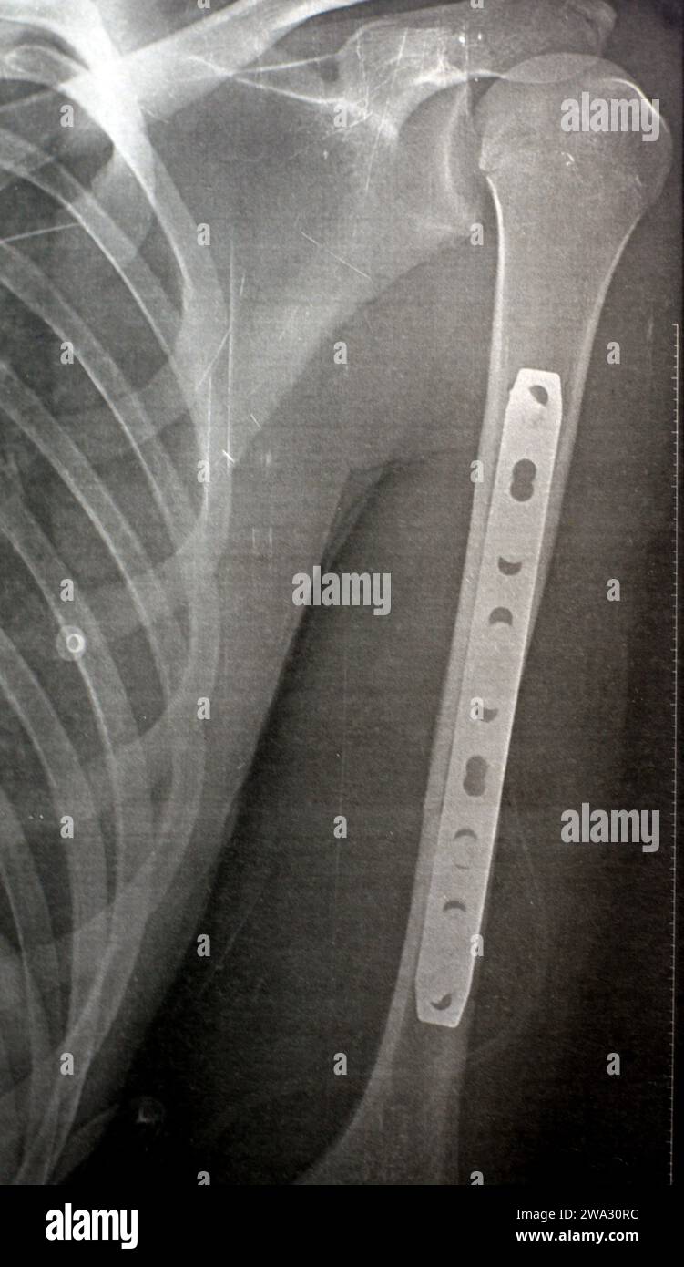 Einfaches Röntgenbild mit linker Oberarmfraktur im Mittelschaft durch direktes Trauma bei einem Autounfall, behandelt durch offene Reposition und innere Fixa Stockfoto