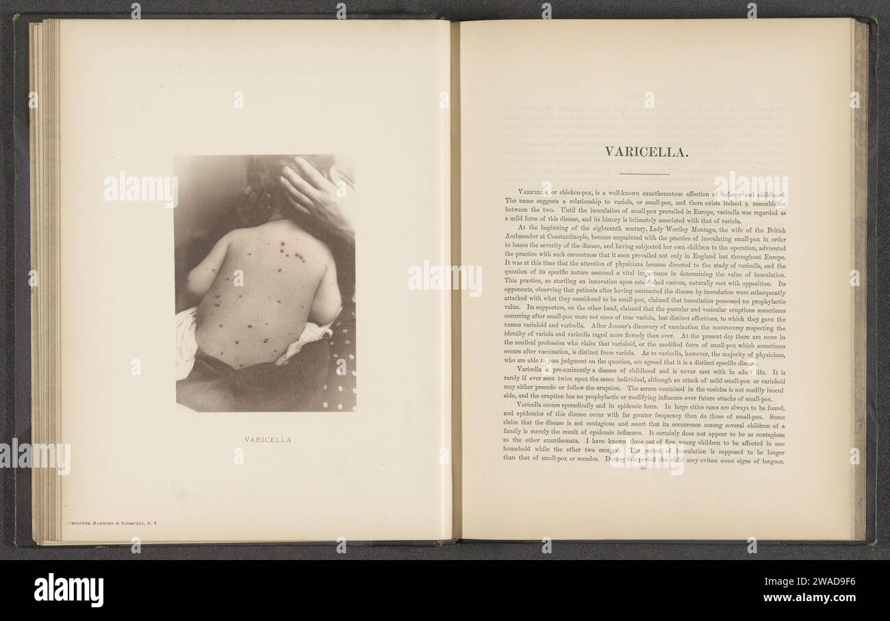 Patient mit der Hautkrankheit 'Varicella', um 1870 - in oder vor 1881 photomechanischer Druck New York (City) Papier kollotypischer Haut- und Geschlechtskrankheiten. Kind Stockfoto
