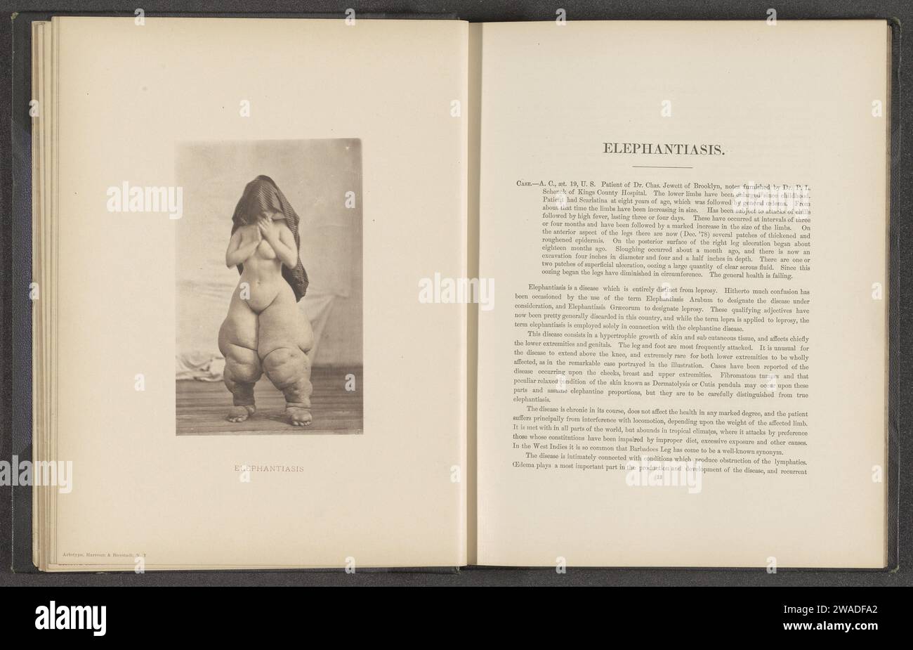 Patient, der an der Hautkrankheit 'Elephantiasis' leidet, um 1870 - in oder vor 1881 photomechanischer Druck New York (Stadt) Papier kollotypischer Haut- und Geschlechtskrankheiten. Erwachsene Frau Stockfoto