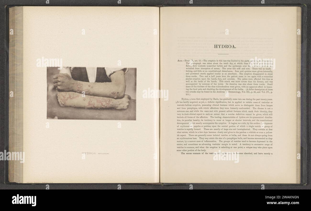 Patient, der an der Hautkrankheit 'Hydroa bullosum' leidet, um 1870 - in oder vor 1881 photomechanischer Druck New York (City) Papier kollotypischer Haut- und Geschlechtskrankheiten. Arme Stockfoto