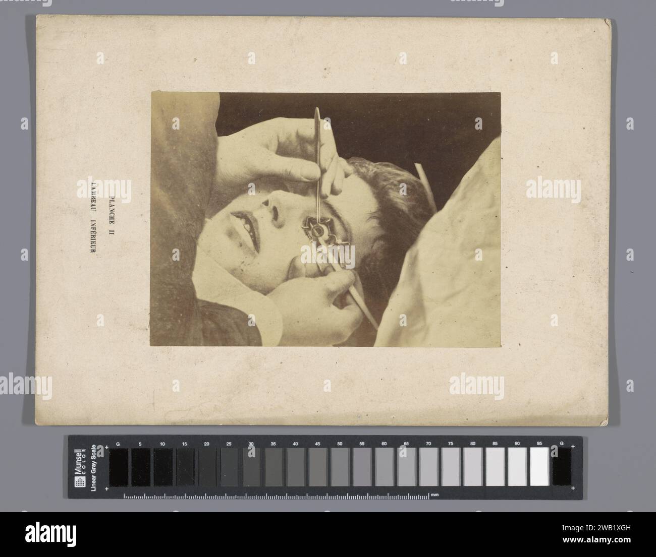 Operation am Unteraugenlappen, A. de Montméja, um 1865 - vor ca. 1870 Foto Frankreich fotografische Trägeralbumendruckoperation, Chirurgie. Augenbehinderungen. Augen Stockfoto