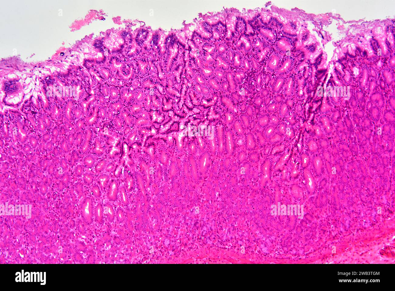 Menschlicher Magen in Kardie-Region. X25 bei 10 cm Breite. Stockfoto