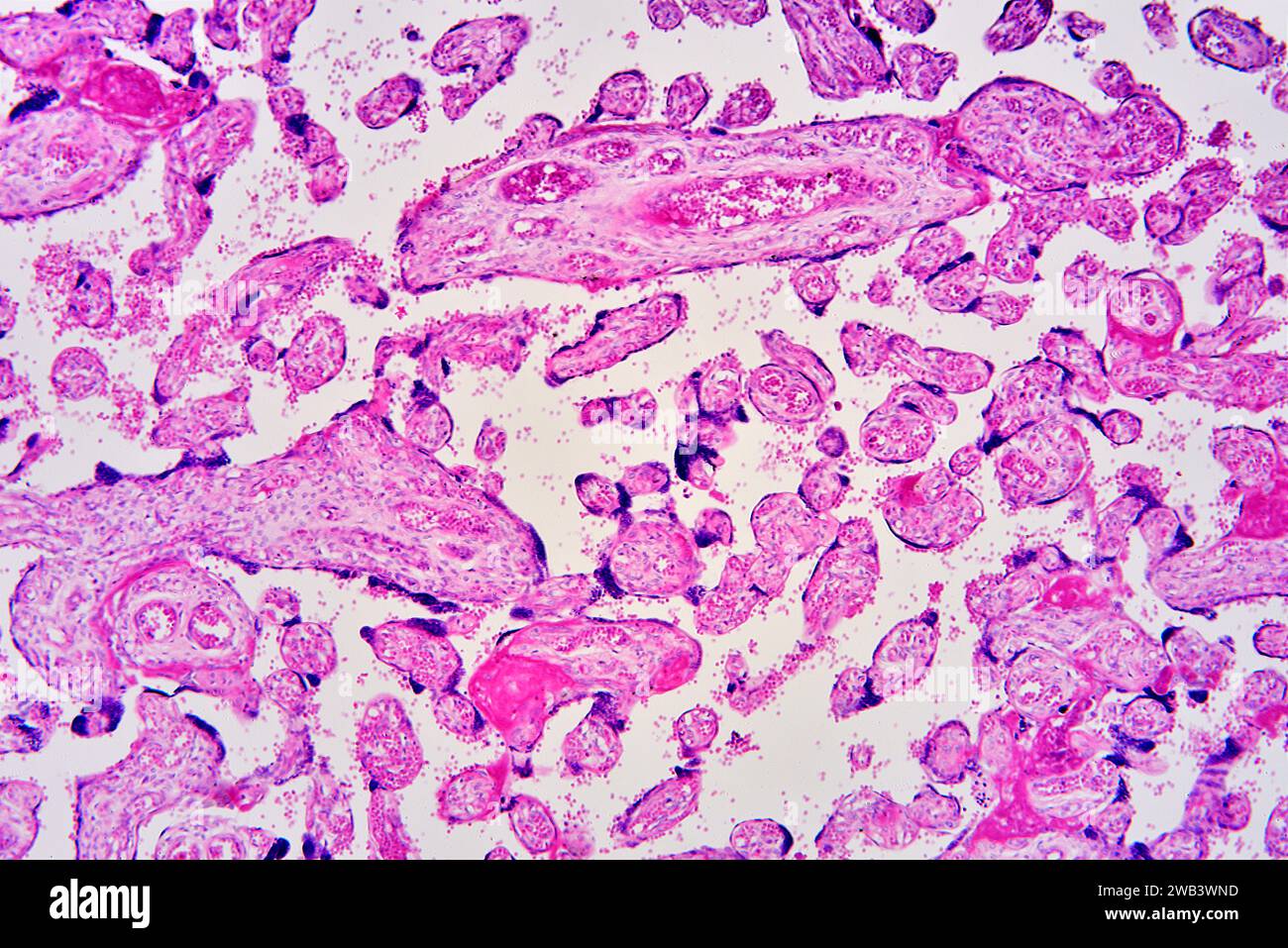 Menschliche Plazenta mit Chorionzotten, Blutgefäßen und roten Blutkörperchen. X 75 bei 10 cm Breite. Stockfoto